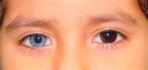 odd eyes human|Heterochromia: Causes, Types, Risk Factors, and Treatment.